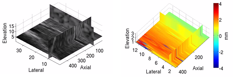 3D speckle tracking of liver data